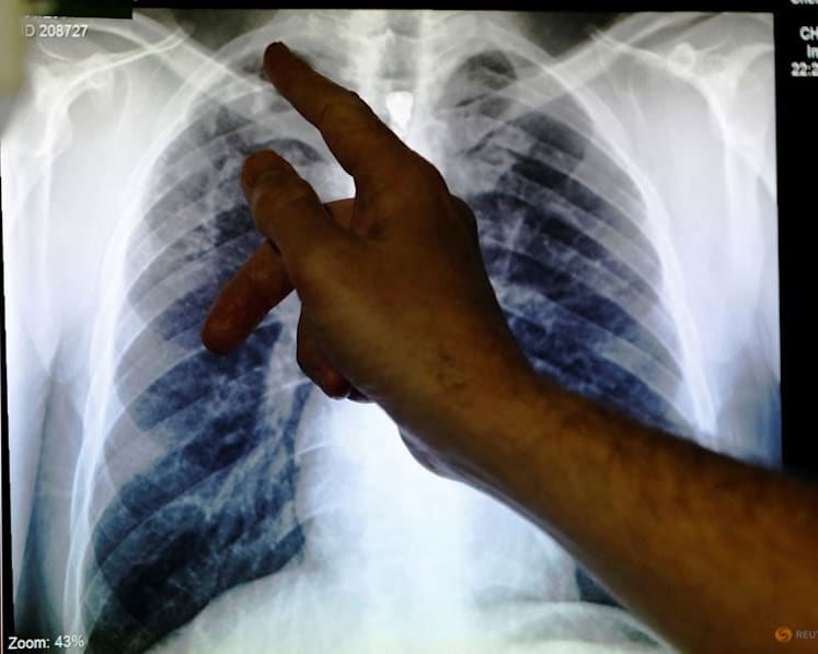 Commentary: We’re losing ground in the global fight against tuberculosis