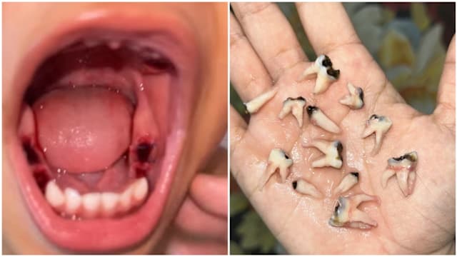 马国男童长期喝奶后不刷牙 被逼一次过拔掉12颗蛀牙