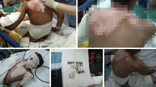 楼上邻居用苏打粉通渠 引发爆炸兄妹惨遭灼伤