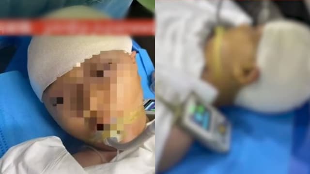 中国老师打伤女学生 导致她头骨碎裂得开颅