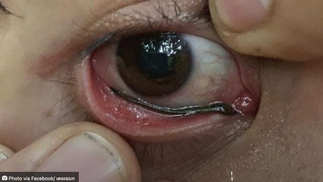 泰男出游把相机搁地上 水蛭竟爬上相机钻进他眼里
