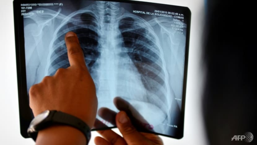 Commentary: Why are there tuberculosis cases in Singapore when most have taken the BCG jab?