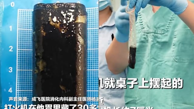 四川男酒后打赌吞打火机 30年后医生用安全套取出