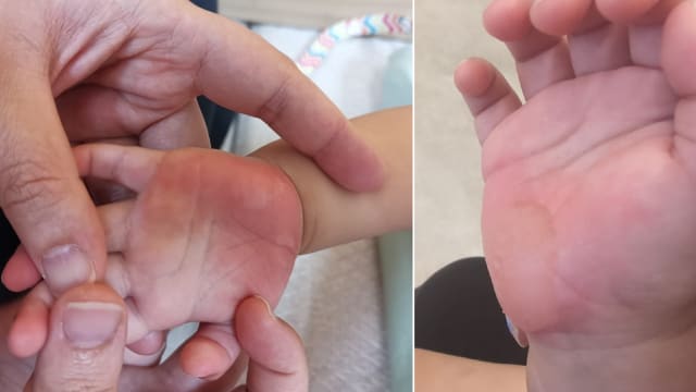宝宝在托婴中心灼伤双手 幼儿培育署已展开调查