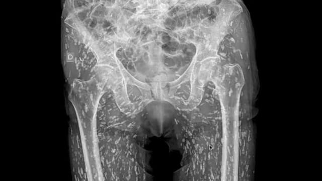 美国男吃未煮熟猪肉 照X光片惊见下身遍布寄生虫卵