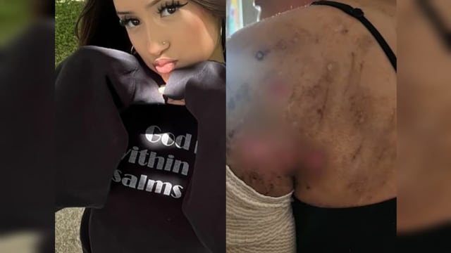 美国少女晨跑遭16犬围攻  缝逾500针保住一命