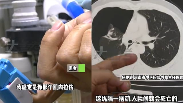 年后为减肥运动过猛 中国男子竟“肺炸了”