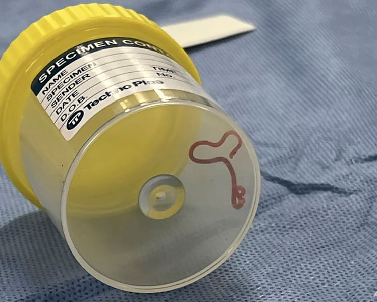 Commentary: Brain worms are rare - but other forms of parasitic infection are common