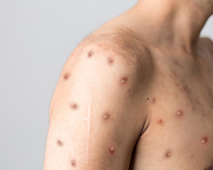 Singapore confirms one more imported case of monkeypox infection