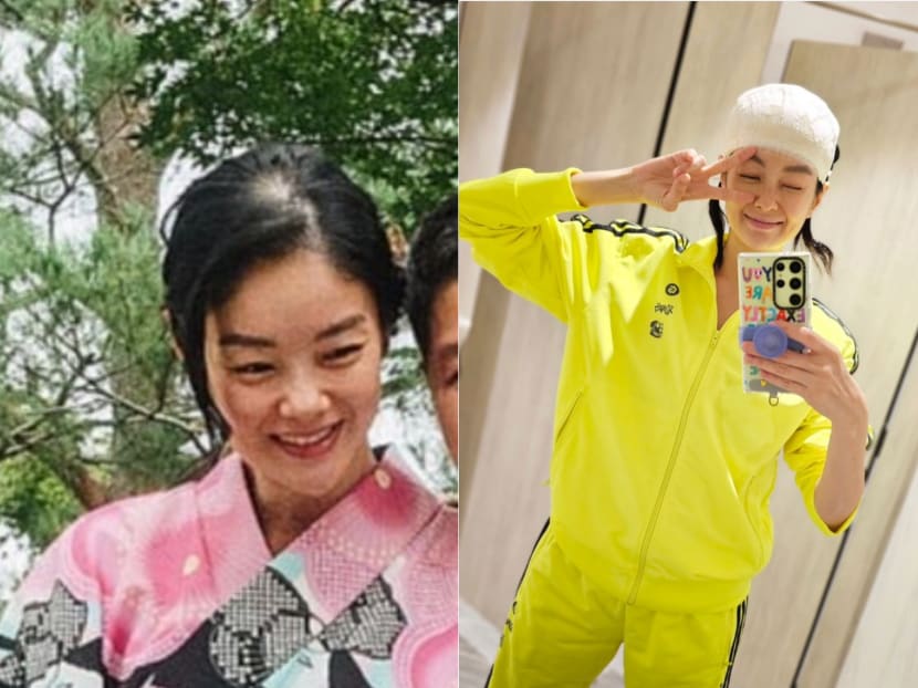 Actress-model Sheila Sim opens up about hair transplant journey to fix ‘prominent bald spot’