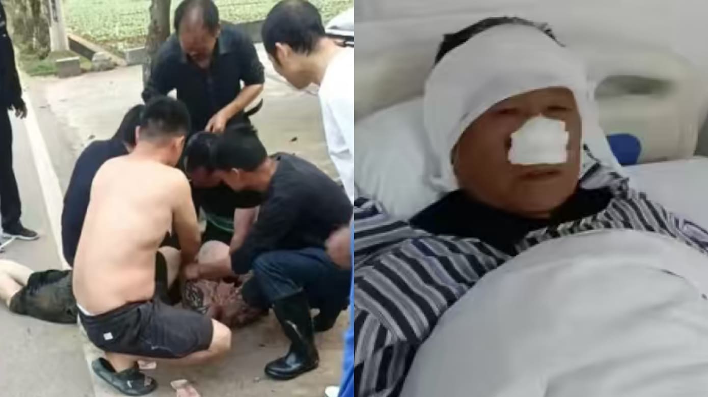 湖南七旬老人挺身救人 鼻子被咬掉伤势严重