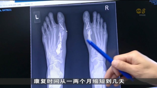 先进微创手术治疗拇囊炎 复原更快伤疤更小
