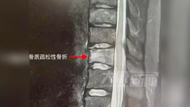 中国25岁女子每日喝四杯咖啡 弯腰骨折确诊骨质疏松
