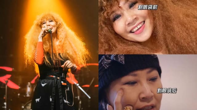 分享割眼袋经历　张蔷喊话医生：我对你很不满意