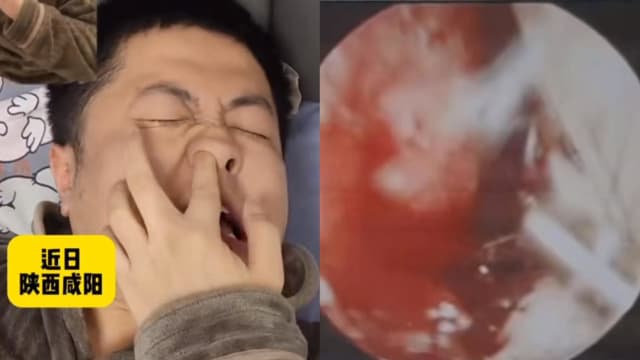 中国男爱挖鼻孔致动脉血管破裂 送院动手术