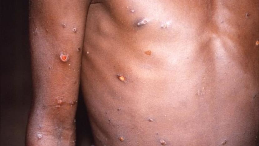 Monkeypox: All 22 close contacts complete their quarantine and remain symptom-free
