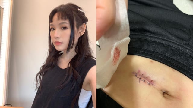 动刀清除肚子数十个囊包　文慧如手术台上痛哭