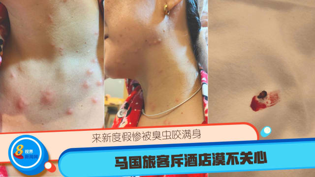来新度假惨被臭虫咬满身 马国旅客斥酒店漠不关心