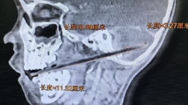广东六岁男童吃麦芽糖摔倒 竹签从口腔刺入小脑