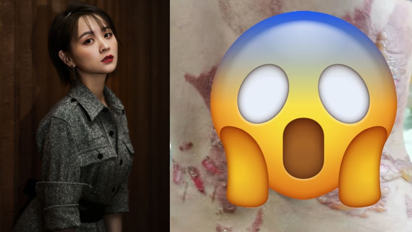 Yanxi Palace Actress Suffers Second-Degree Burns After Cupping Session Accident
