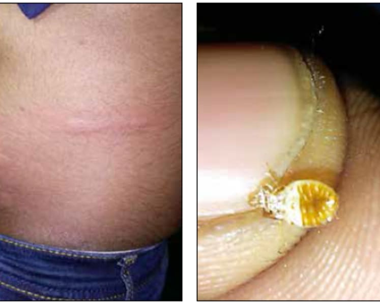 Passenger complains of bedbug bites on Singapore-bound coach ride from KL