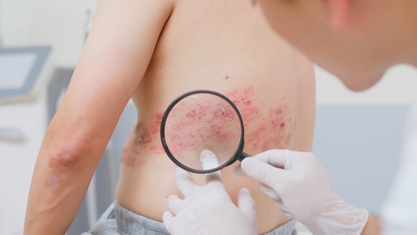 Shingles vaccine linked to fewer heart attacks and strokes, study suggests – what you need to know