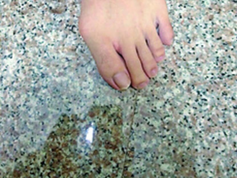 Bunion surgery now offers more pros than cons