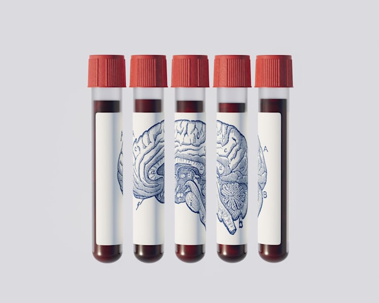 Could a blood test predict if you’ll get Alzheimer’s years before symptoms appear?