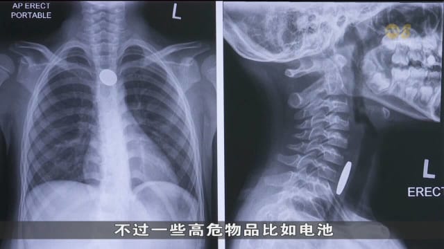 研究：儿童误食异物后若不取出 逾80%物体两周内会排出体外