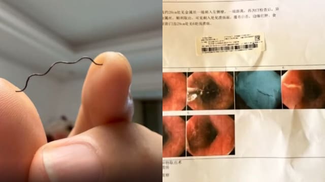 吃火锅吃出铁丝 中国女子喉咙六处划伤
