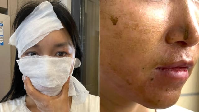 李子柒制漆器严重过敏，脸包纱布肿成“电视机”
