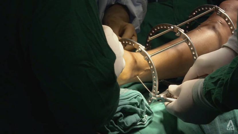 Is bone-breaking surgery to grow taller worth the risk?