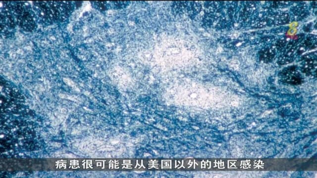 美国纽约州传出近十年来首起小儿麻痹症病例