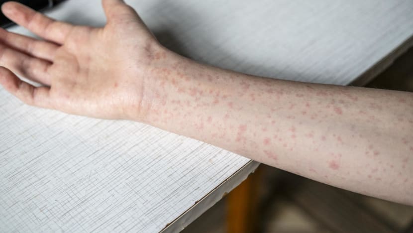 CNA Explains: Is Singapore at risk of a measles comeback? CNA Explains: Is Singapore at risk of a measles comeback?