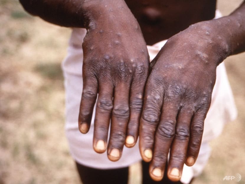 Commentary: Four ways the monkeypox outbreak can play out