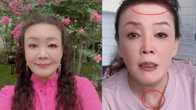 病因不明、无法根治　张兰罹患“白癜风”！