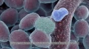 Colorectal Cancer