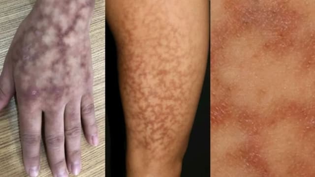 睡前用热水袋出现“低温烫伤” 中国妇女手脚出现“蟒蛇纹”