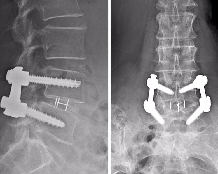 Keyhole spine surgery saved 79-year-old’s back – and sanity