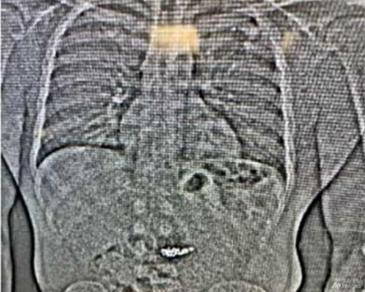 X-ray shows US$770,000 diamond earrings swallowed by theft suspect during arrest: US police
