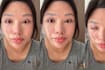 Woman Left Unable To Close Eyes After Botched Double Eyelid Surgery