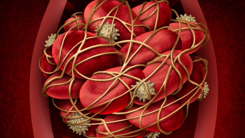 Covid-19-induced blood clots: What to know if you have diabetes, hypertension or other health issues
