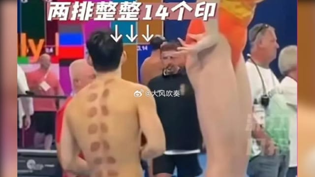  巴黎奥运又见“东方神秘力量” 中国游泳选手背部满满拔罐印