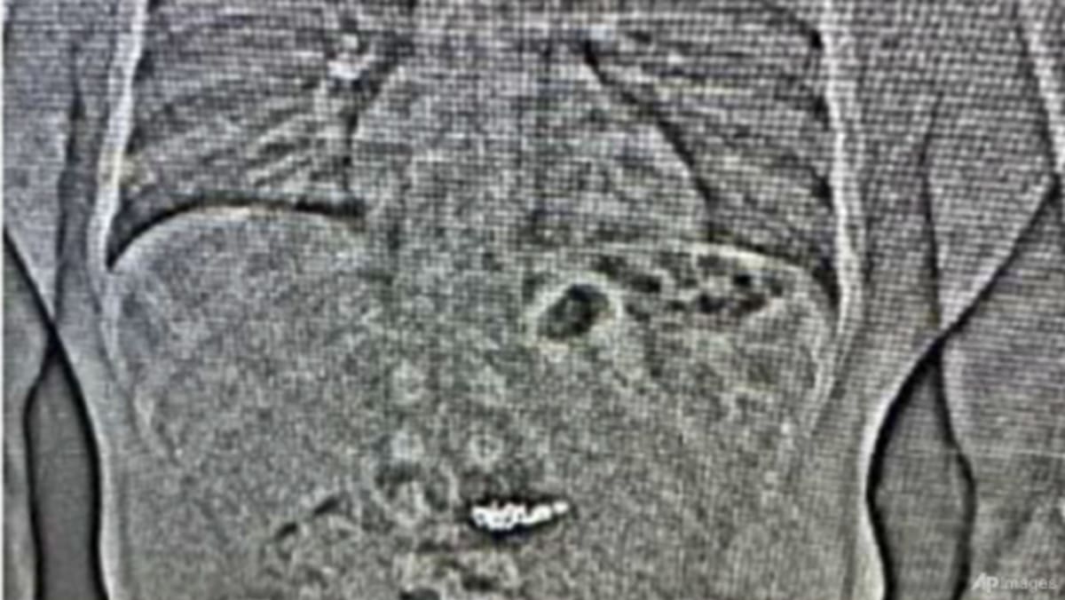 X-ray shows US0,000 diamond earrings swallowed by theft suspect during arrest: US police X-ray shows US0,000 diamond earrings swallowed by theft suspect during arrest: US police