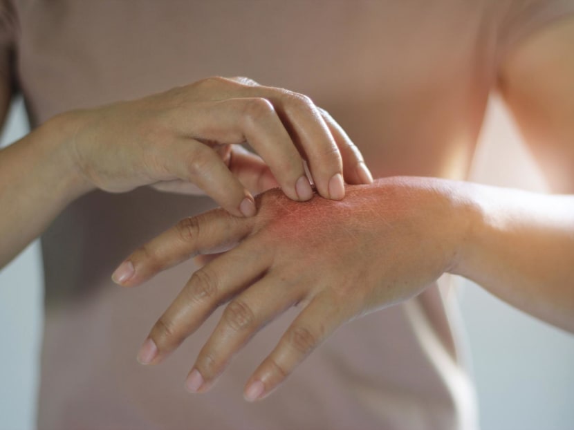 How to stop scratching and soothe an itchy bug bite, from medicines to mental tricks