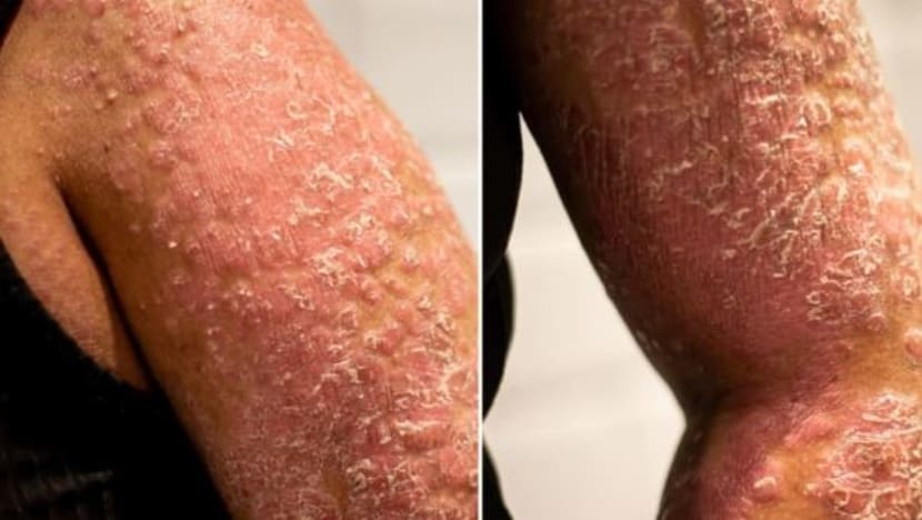 "Bau seperti ikan busuk, sakitnya bukan kepalang," luah pesakit kulit ini