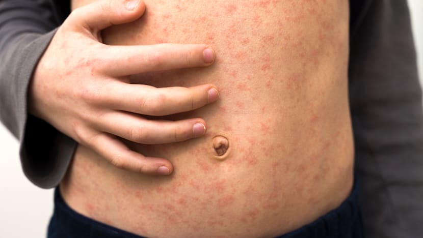 தட்டம்மைக்கு எதிராக பாலர்பள்ளிகளிலும் மருத்துவமனைகளிலும் முன்னெச்சரிக்கை நடவடிக்கைகள்