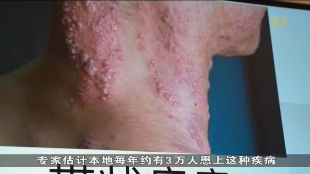 本地带状疱疹病例上升 医生：过去两年增10%