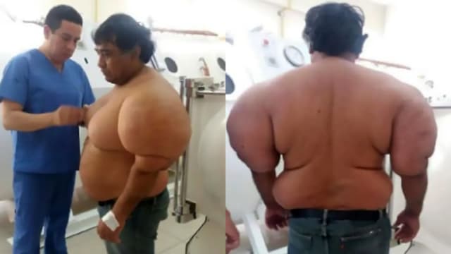 秘鲁潜水员体内“卡氮气”十年　手臂如吹气般膨胀无药可治