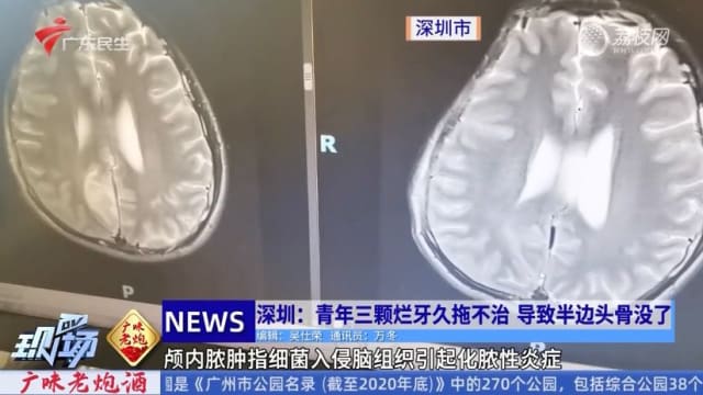 三颗蛀牙引发脑感染 中国青年险丢命